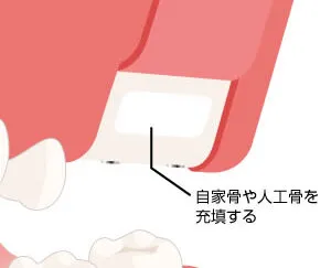 サイナスリフト