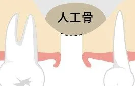 ソケットリフト