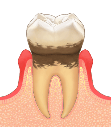 中等度の歯周炎