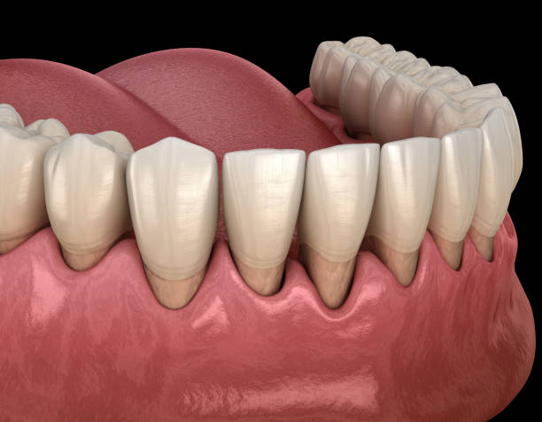 歯茎の状態