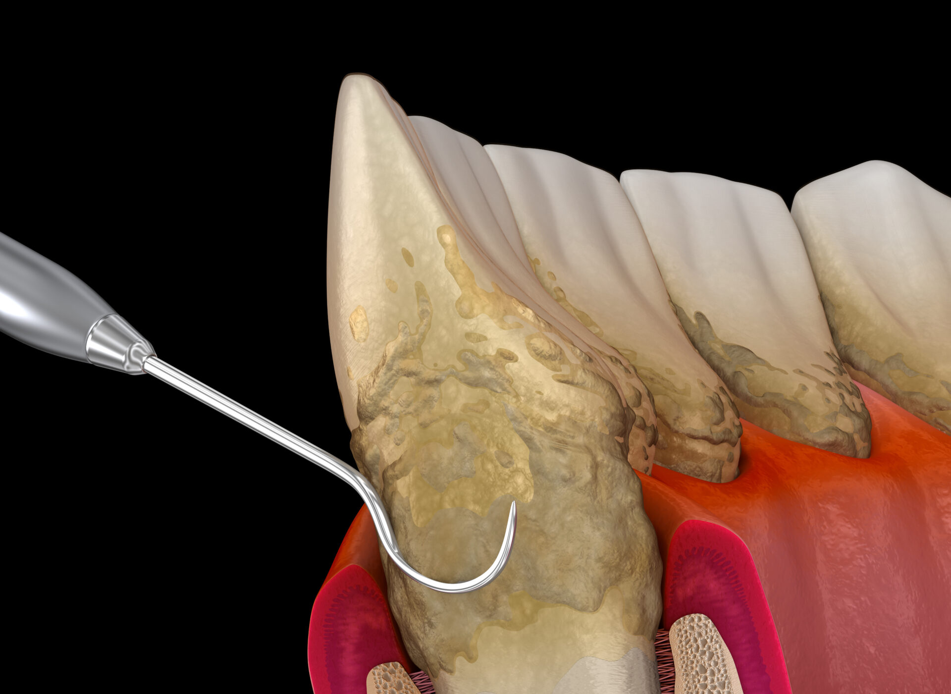 Oral hygiene: Scaling and root planing of Periodontitis stage 3 (conventional periodontal therapy). Medically accurate 3D illustration of human teeth treatment