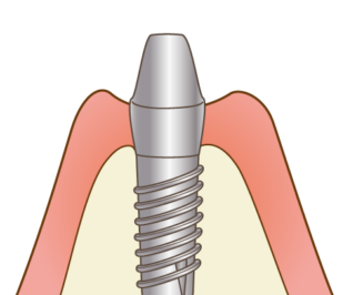 インプラント　アバットメント